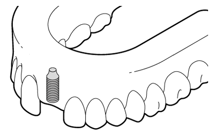 A representation of the healed jaw bone after placement of the dental implant