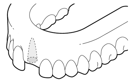 An example of the upper jaw missing a tooth with the jaw bone unhealed