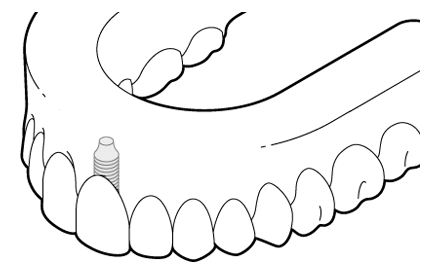 An example of a fully restored tooth using a dental implant